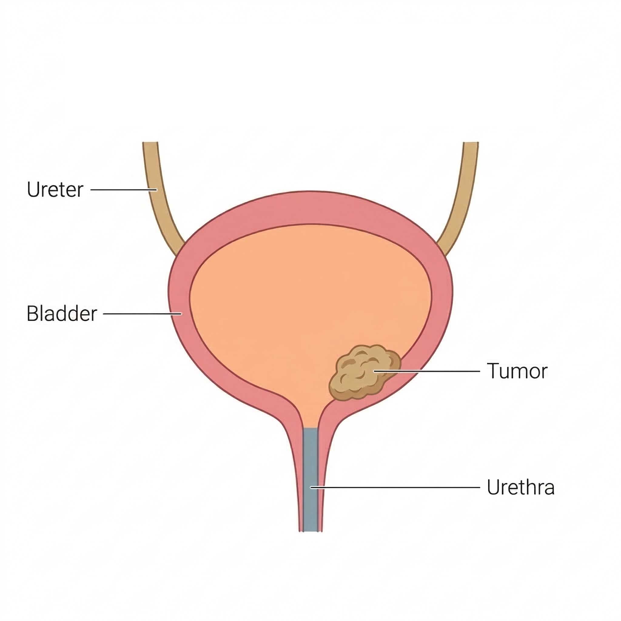 Simple diagram of what a bladder with a tumor could look like.<br />
