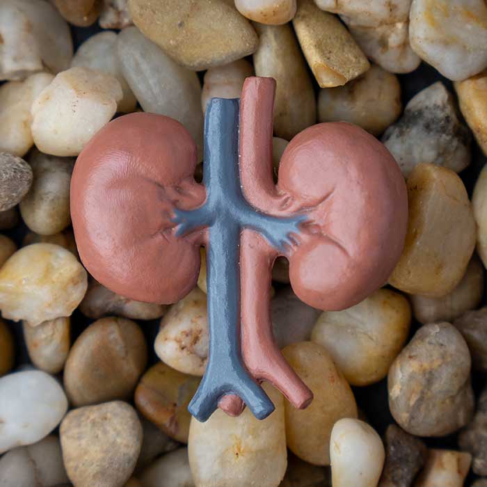 What are kidney stones